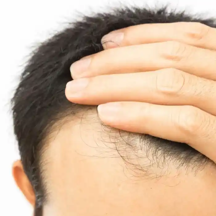 Saç Ekimi Tedavisi Ne Kadar Sürer ?